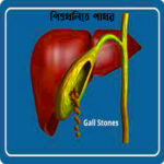 gall stone